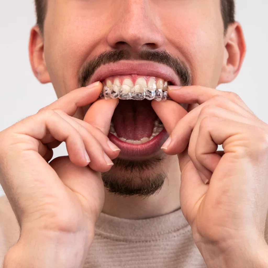 man putting on clear aligners | best clear aligner dentist near you
