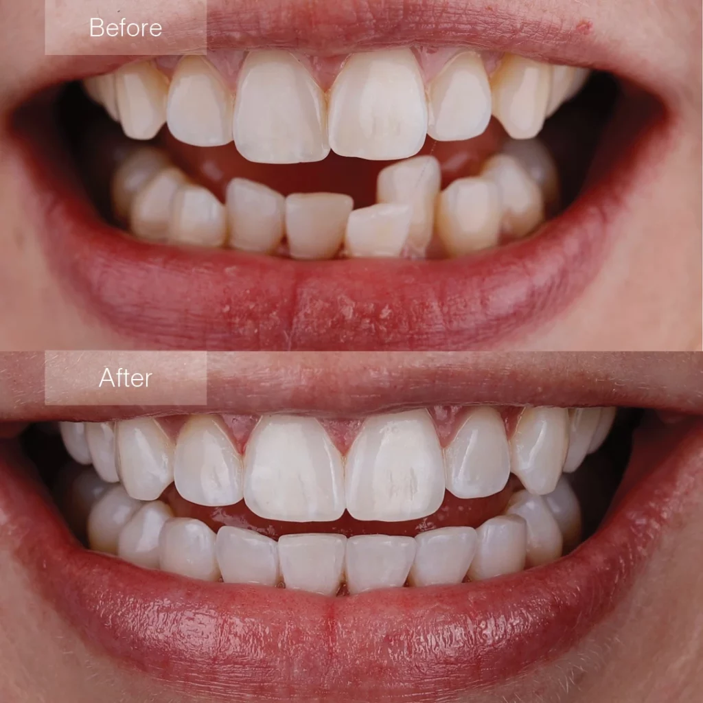 before and after clear aligners