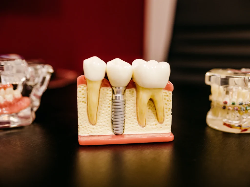 model of a single tooth dental implant | cost of dental implants in Deep River, CT