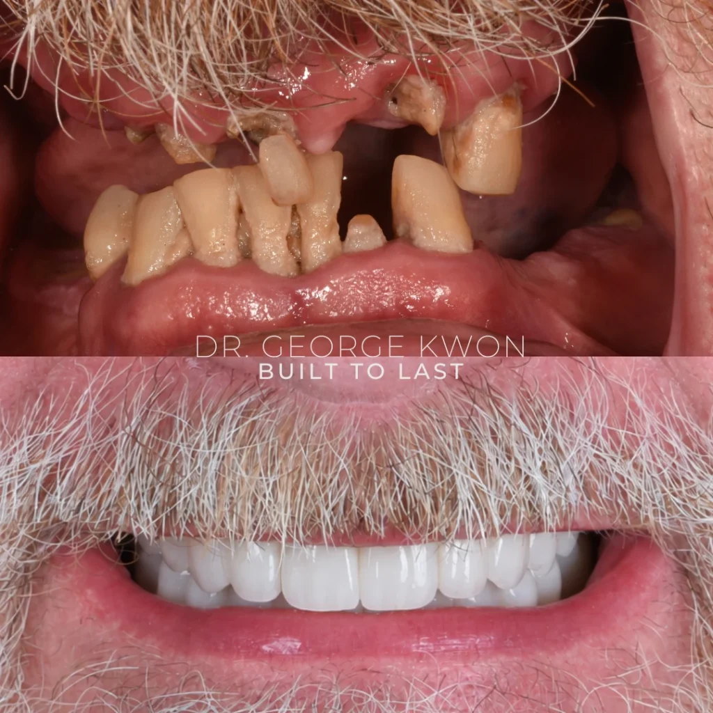 Before and after All-On-4 dental implants in Deep River, CT at Deep River Family Dental.