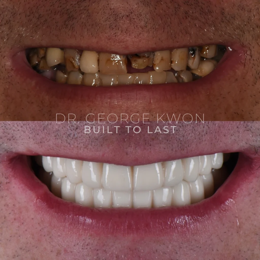 Before and after All-On-4 dental implants in Deep River, CT at Deep River Family Dental.