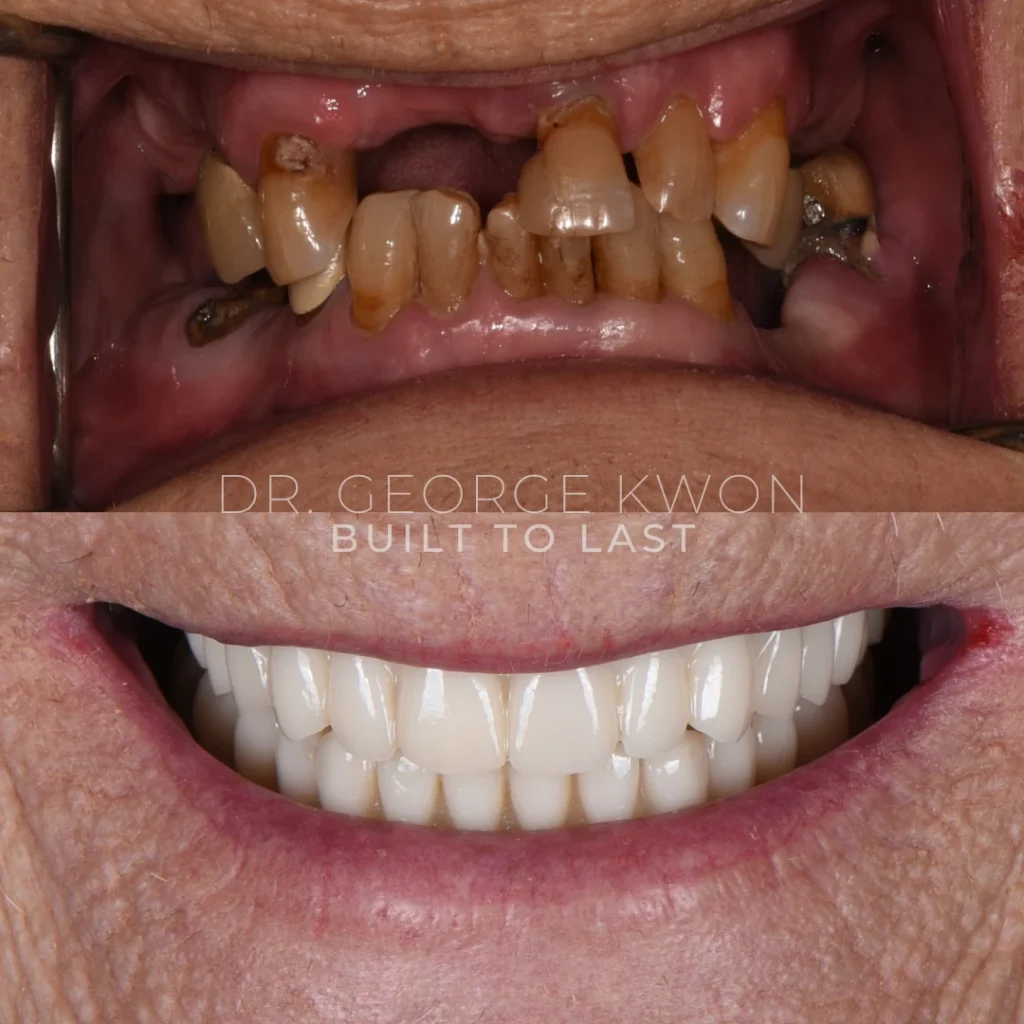 Before and after All-On-4 dental implants in Deep River, CT at Deep River Family Dental.