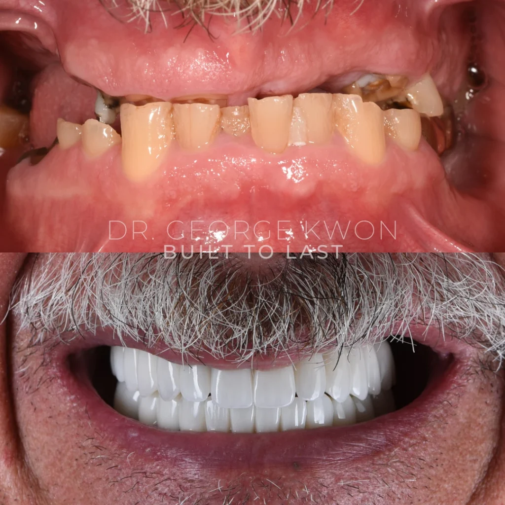 Before and after All-On-4 dental implants in Deep River, CT at Deep River Family Dental.