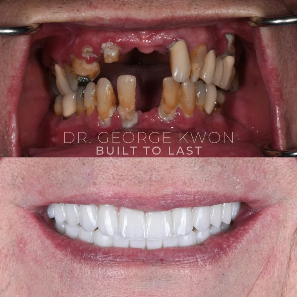 Before and after All-On-4 dental implants in Deep River, CT at Deep River Family Dental.
