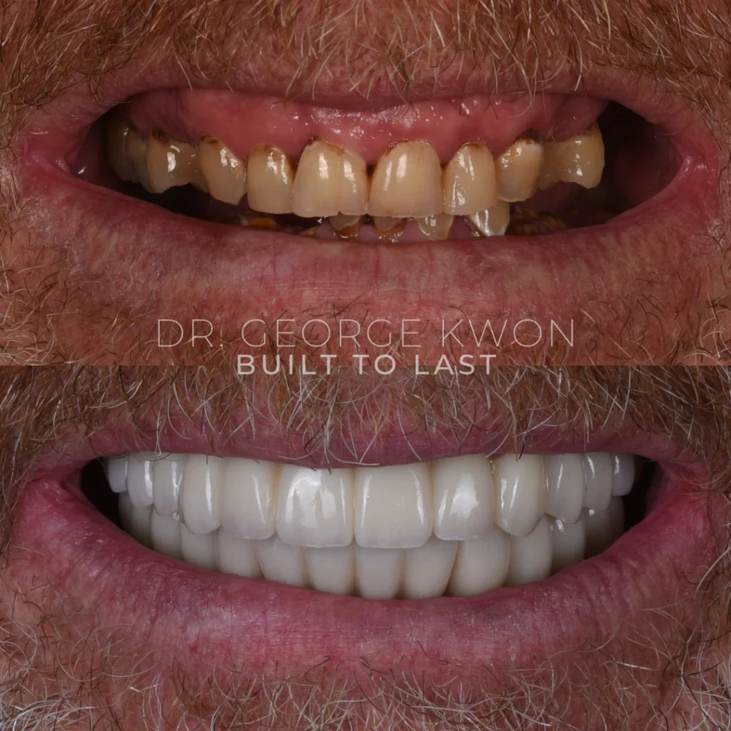 Before and after All-On-4 dental implants in Deep River, CT at Deep River Family Dental.